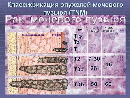 Ответы на тесты нмо рак мочевого пузыря