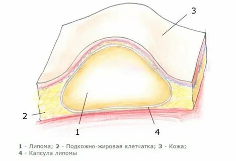 Доброкачественное новообразование жировой ткани кожи