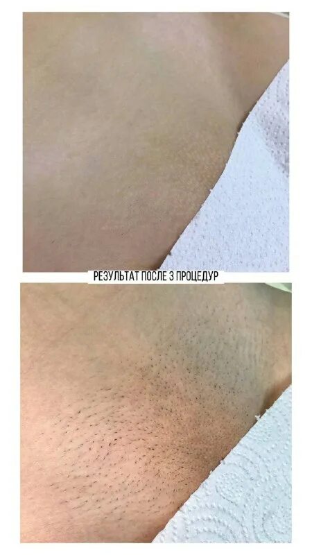 лазерная эпиляция врастают ли волосы. пигментация от вросших волос. плоский колготочный тип вросших волос. диодный лазер глубокое бикини. врастают ли волосы после лазерной эпиляции.