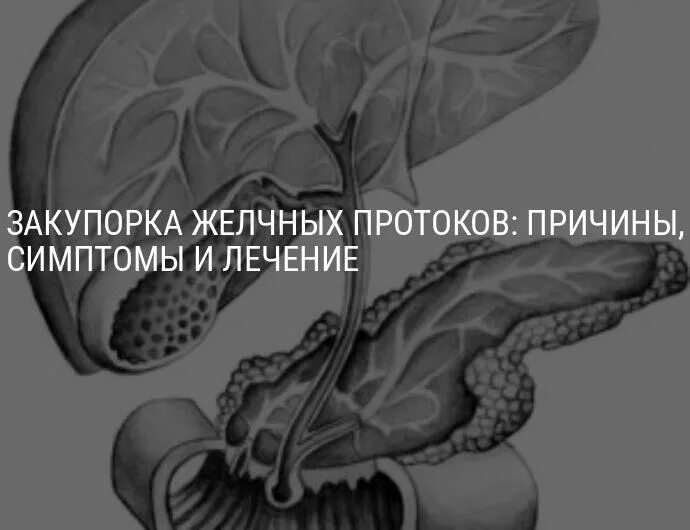 Симптомы забитых желчных протоков. Непроходимость желчных протоков. Закупорка желчных протоков. Обструкция желчного протока. Закупорка общего желчного протока.