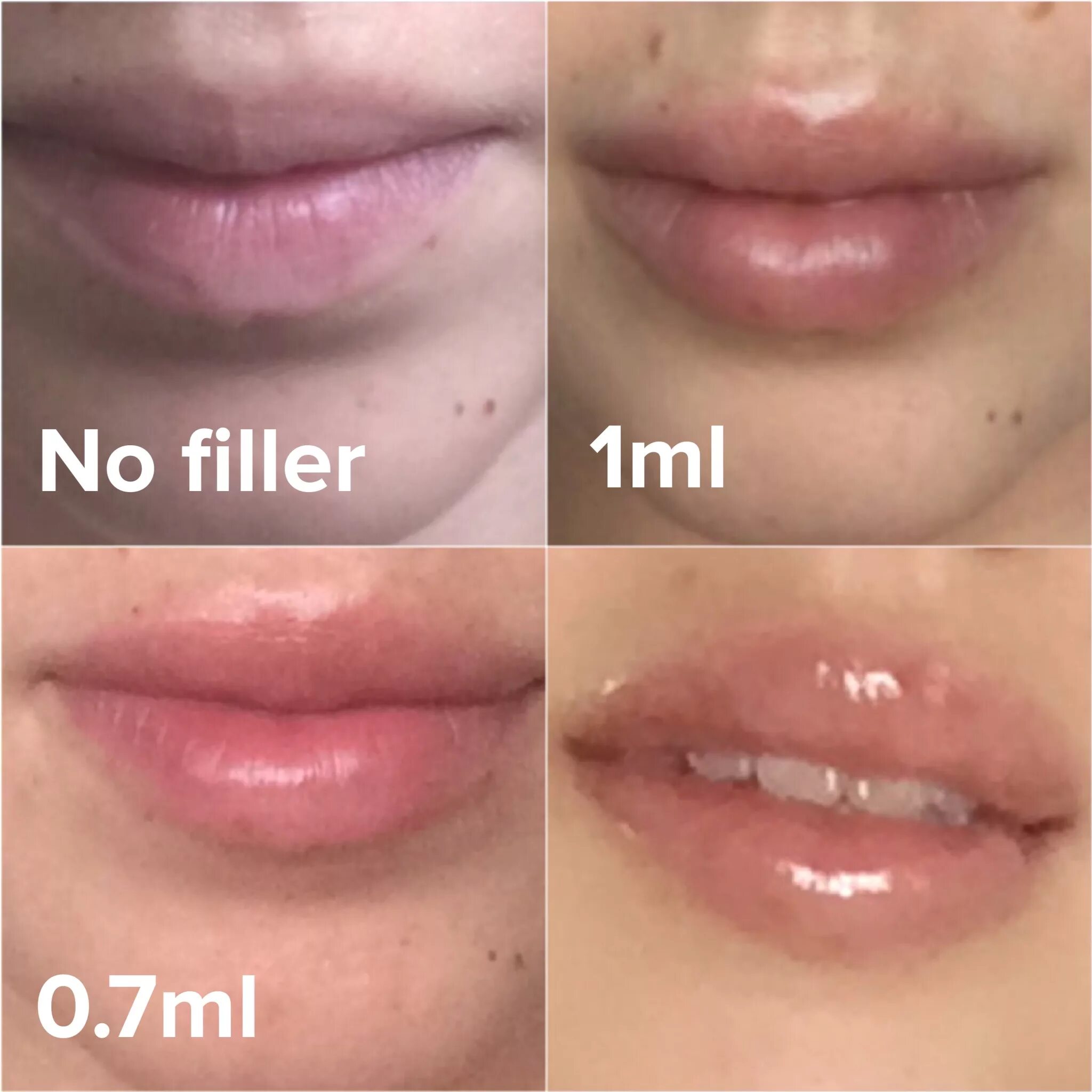 0.5 в губы до и после фото. 1 Мл гиалуроновой кислоты в губы после заживления. Губы 1 мл гиалуроновой зажившие.