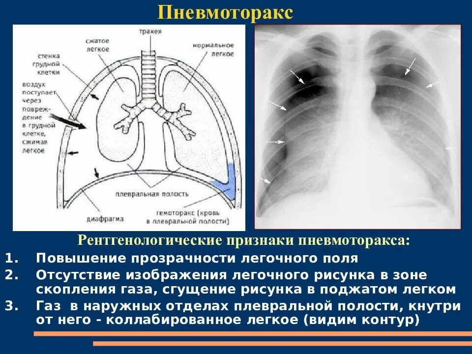 Спонтанный пневмоторакс рентген картина. Пневмоторакс рентген описание. Пневмоторакс рентген симптомы. Пневмоторакс лучевая диагностика.