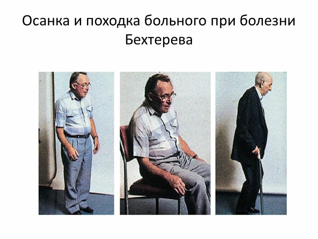 Болезнь паркинсона. Терапия болезни паркинсона. Бехтерева паркинсона. Синдром пизанской башни при болезни паркинсона. Походка при болезни бехтерева.