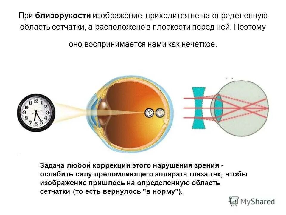 Слабая миопия глаза что. Близорукость (истинная и ложная формы патологии). Близорукость миопия. Близорукость сетчатка. Зрение при близорукости.