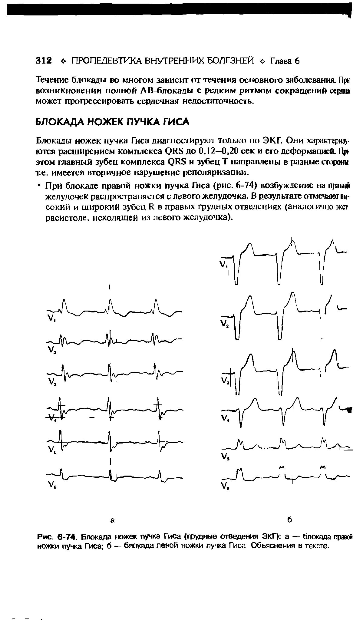 Блокада правого желудочка. Блокада левой ножки пучка Гиса на ЭКГ. Блокады ножек пучка Гиса на ЭКГ расшифровка. Полная и неполная блокада левой ножки пучка Гиса. Одновременная блокада правой и левой ножек пучка.