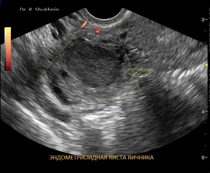 Какая норма кисты. Эндометриоидной кисты яичника. Эндометриоидные кисты яичника. Эндометриоидные кисты яичника на УЗИ.