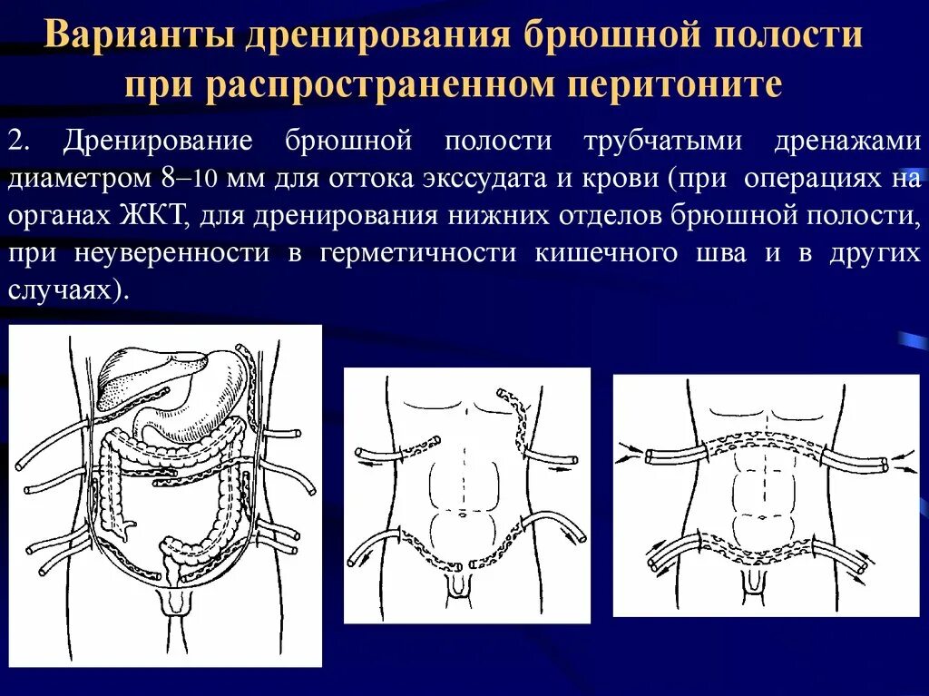 Аппендэктомия послеоперационный. Дренирование послеоперационных РАН. 4 Точки для дренирования брюшной полости. Аспирационное дренирование брюшной полости. Редринирование брюшной поло.