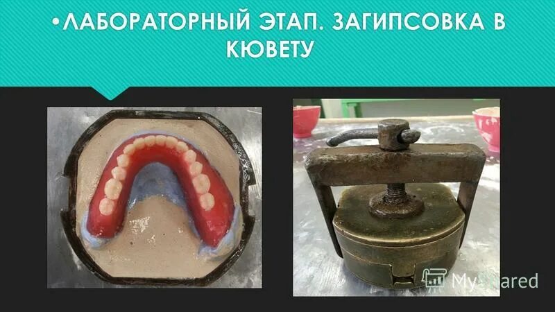 Замена базиса. Загипсовка в кювету частичного съемного протеза.