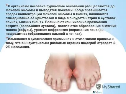 Признаки подагры у мужчин и диета