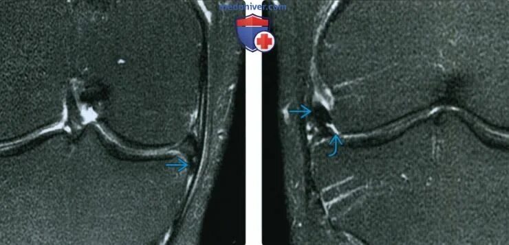 Радиальный разрыв мениска мрт. Мрт коленного сустава разрыв мениска. Дискоидные мениски коленного мрт.