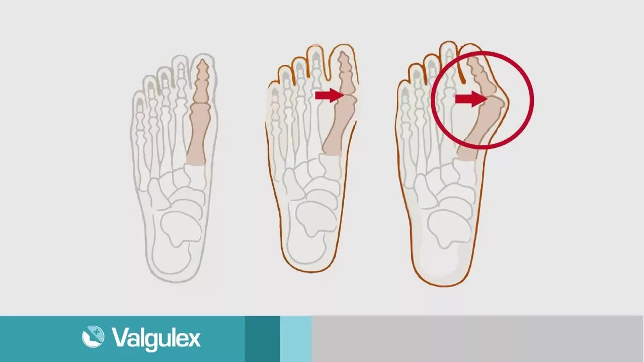Вальгусная стопа у взрослых операция. Деформация халюс вальгус. Деформация стопы халюс вальгус.