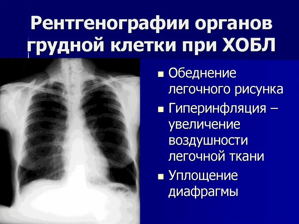 Эмфизема хронического бронхита. Рентгенография органов грудной клетки ХОБЛ. Рентген грудной клетки ХОБЛ. Рентген при бронхитическом ХОБЛ. ХОБЛ на рентгене легких.