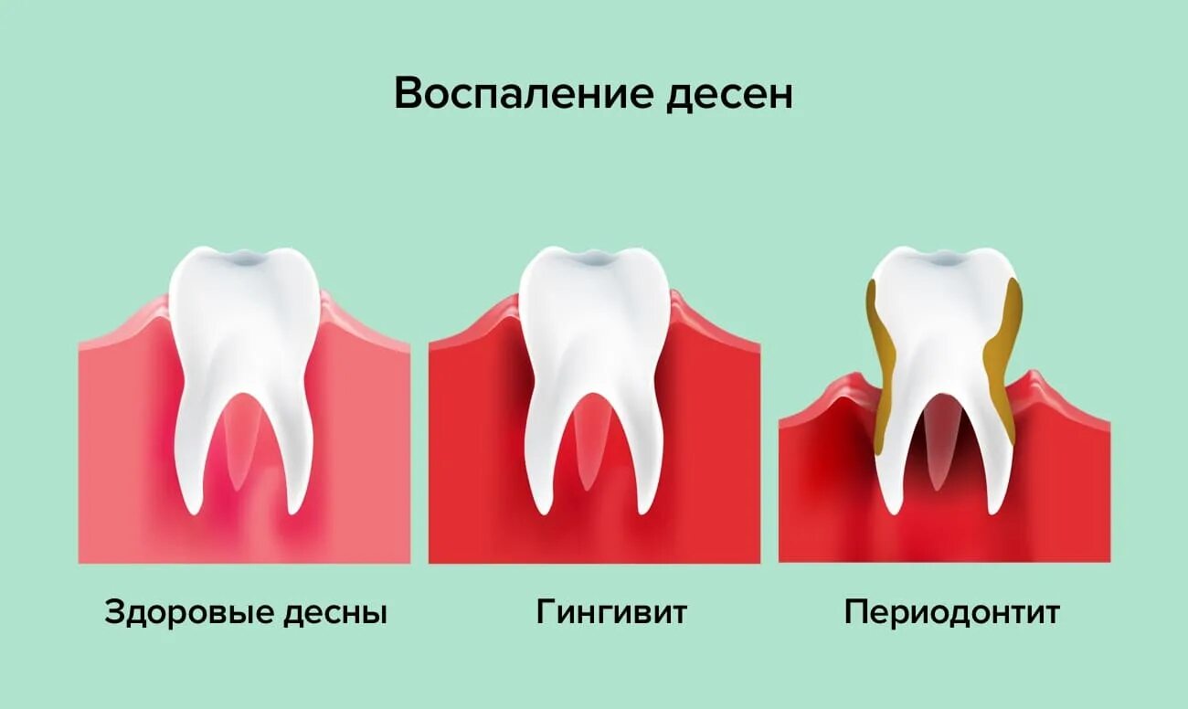 Здоровые зубы и пародонтоз.