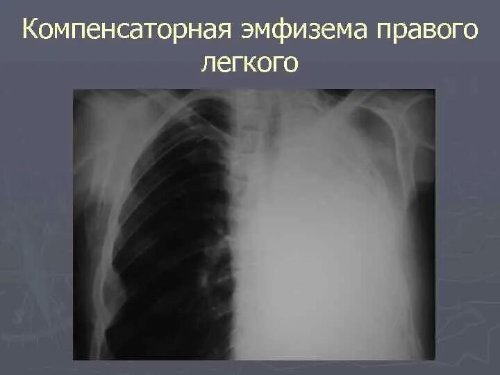 Эмфизема легких характеризуется:. Хронический диссеминированный туберкулез рентген. Викарная эмфизема. Викарная эмфизема. Парасептальная буллезная эмфизема.