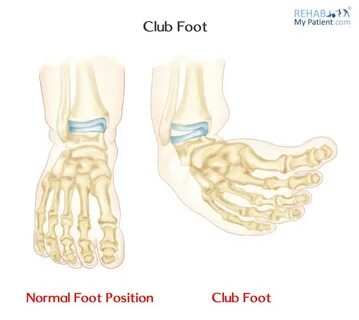 Club foot