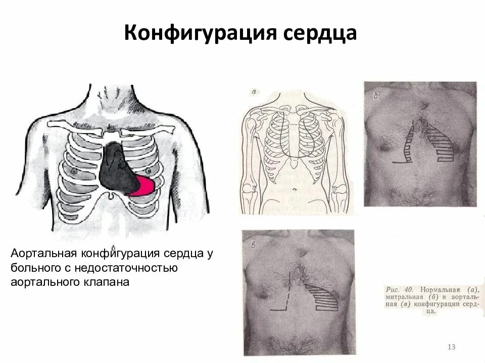 Конфигурации сердца. Митральная недостаточность конфигурация сердца. недостаточность аортального клапана конфигурация сердца. патологические конфигурации сердца. нормальная конфигурация сердца схема.