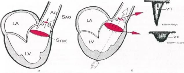 Выносящий тракт левого желудочка. Систолическая функция левого желудочка. Диаметр выносящего тракта левого желудочка в норме. Сегменты левого желудочка ЭХОКГ схема.