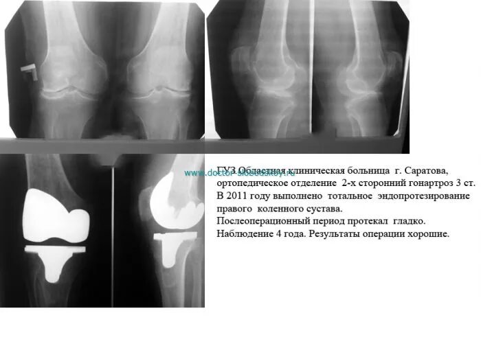 Форум после эндопротезирования коленного сустава. Эндопротез коленного сустава рентген протокол. тотальный эндопротез коленного сустава рентген. рентгенограммы после эндопротезирования коленного сустава. эндопротез коленного сустава кт.