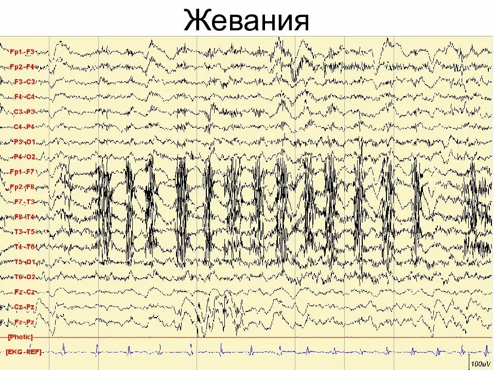 Глоссокинетический артефакт на ЭЭГ это. Миографические артефакты на ЭЭГ что это такое. Артефакт ЭКГ на ЭЭГ. Артефакт моргания на ЭЭГ. Записаться на ээг