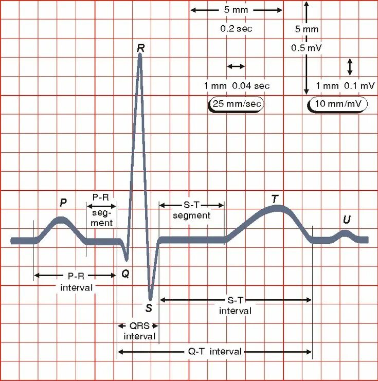 Как считать клетки на ЭКГ. Как считать клеточки на ЭКГ. ЭКГ 50 мм/с 1 клетка. ЭКГ 25 мм/с 1 клетка. Мв на экг