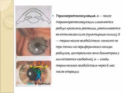 Кривизна глаза