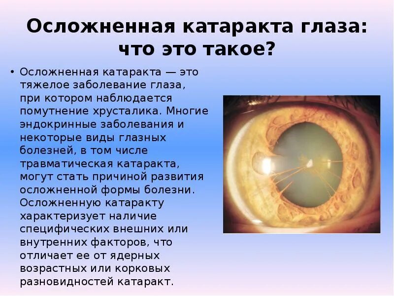 Когда восстанавливается зрение после замены хрусталика. Миопизирующая катаракта. Осложненная катаракта. Осложненная катаракта глаз. Заболевания хрусталика глаза офтальмология.
