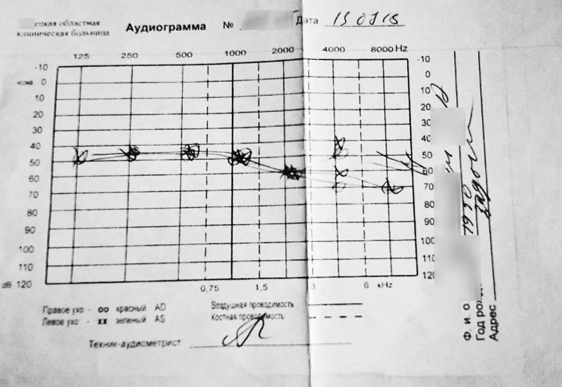 Аудиограмма. Хорошая аудиограмма. Аудиограмма хорошего слуха. Нормальная аудиограмма. Аудиограмма в спб