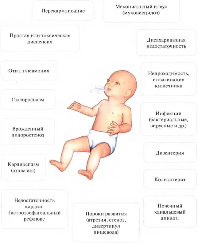 Проблемы с кишечником у ребенка. Мекониевый илеус при муковисцидозе. Мекониевый илеус ирригография. Муковисцидоз кишечная форма мекониальный илеус. Мекониальная непроходимость.