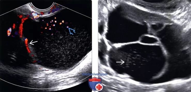 Муцинозная опухоль яичника на УЗИ. Псевдомуцинозная кистома яичника. Папиллярная серозная цистаденома яичника. Муцинозные опухоли яичников