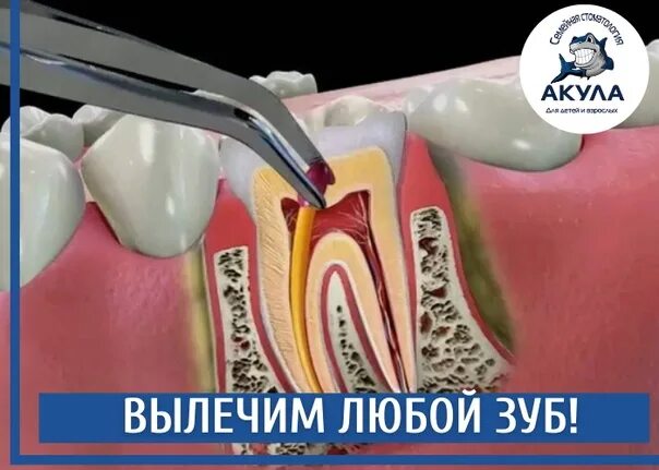 Зуб реагирует на горячее лечение. Зуб реагирует на холодное и горячее.