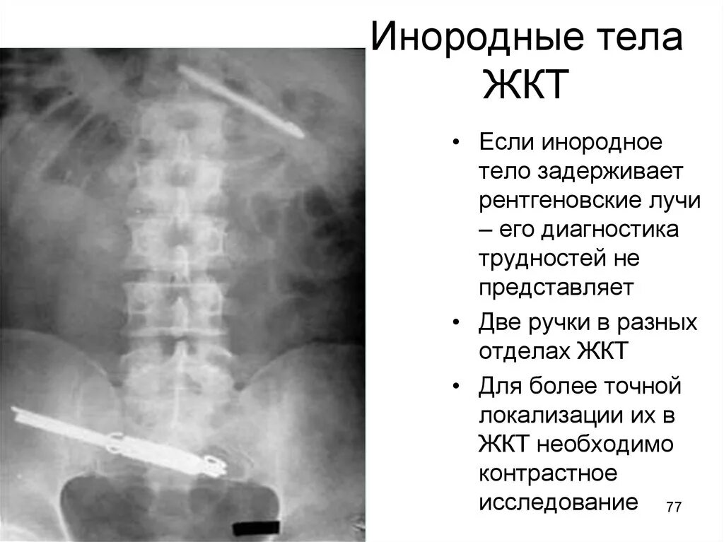 Проглотил через сколько выйдет. Инородные тела желудочно-кишечного тракта. Инородное тело желудка симптомы. Инородное тело в желудке у ребенка.