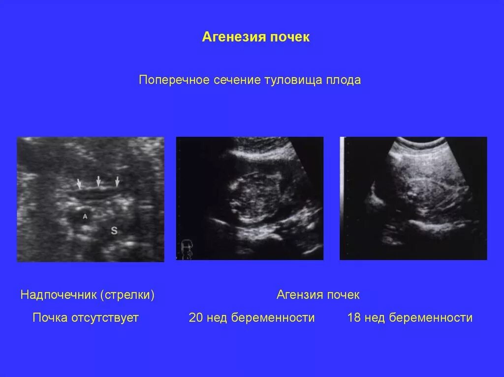 Аномалии развития почек на узи. Нормы почек плода. Нормы почек плода. Норма размера почек у плода по неделям беременности таблица. Норма лоханок у плода в 20 недель.