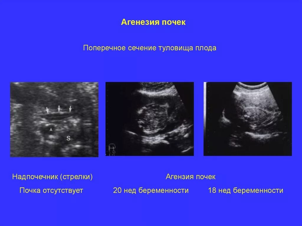 Узи аномалий. Аномалии развития почек УЗИ. Агенезия почки у плода на УЗИ.