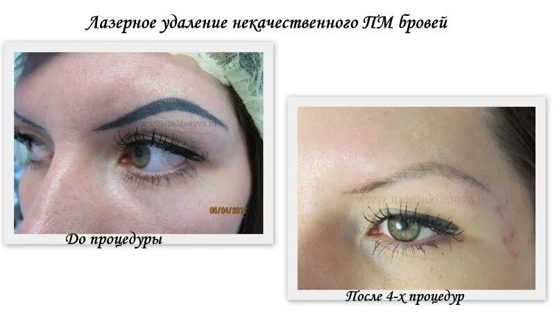 Удалить брови лазером отзывы. Лазер брови. Выведение татуажа бровей лазером. Удалить брови лазером отзывы. Убрать татуаж бровей лазером.