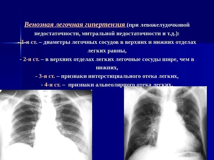 Признаки недостаточности легких. Легочная венозная гипертензия рентген. Легочно-венозная гипертензия стадии. Легочная артериальная гипертензия симптомы. Легочная гипертензия на рентгенограмме.