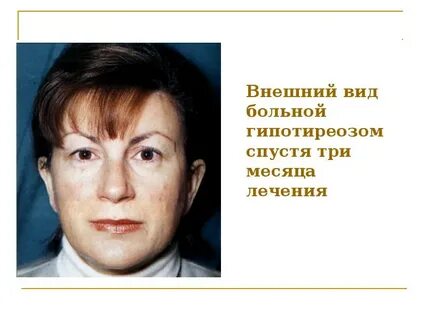 Гипотериоз после лечения