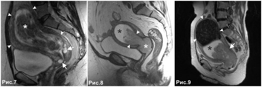 мрт полости матки. мрт полости матки. мрт полости матки. мрт полости матки. тератома малого таза мрт.