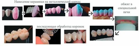 Металлокерамическая коронка этапы