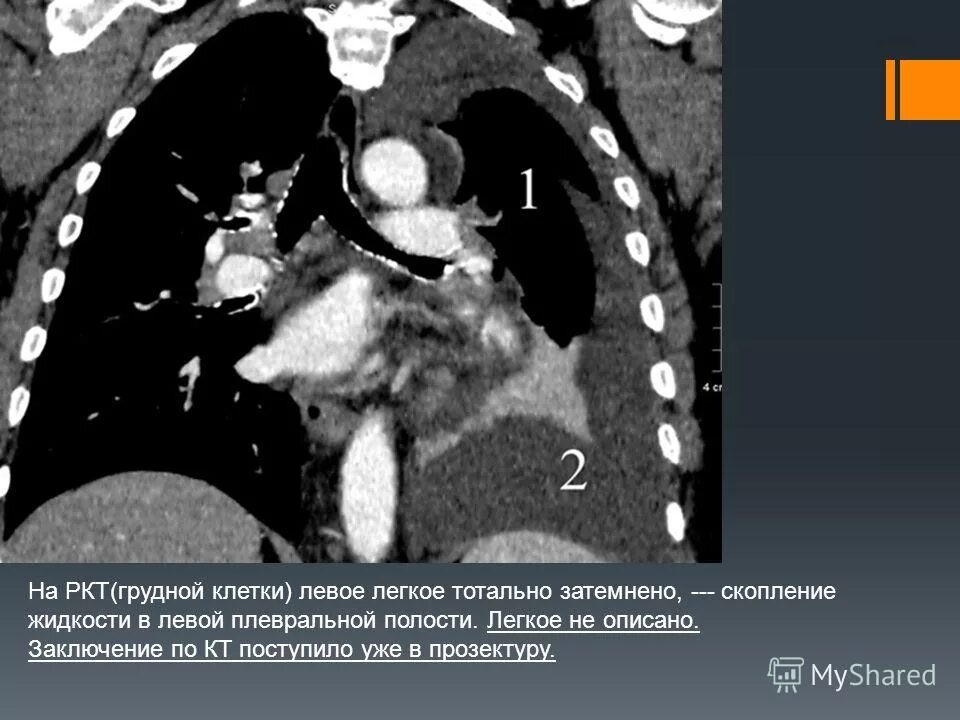 Что такое ркт. Рентгеновская компьютерная томография (РКТ). Возможности РКТ при заболеваниях органов грудной клетки. Компьютерная томография органов средостения. Рентгеновская томограмма грудной клетки.