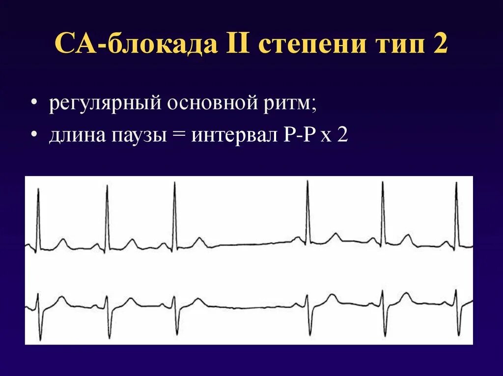 Синоатриальная блокада 2 степени на ЭКГ. Синоатриальная блокада 1 степени на ЭКГ. ЭКГ-признаки са-блокады II степени Мобитц 1. Са блокада 2 степени 2 типа. Са блокада степени