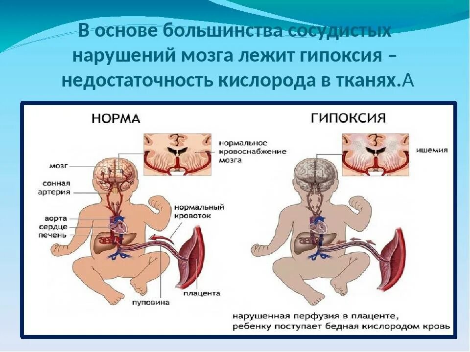 Гипоксия мозга у новорожденного. Нарушение кровообращения у детей. Нарушение мозгового кровообращения у плода. Нарушение кровотока в головном мозге. Нарушение кровотока головного мозга у новорожденных.