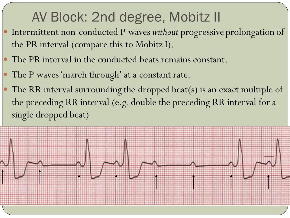 Av block remover сайт. Av Block ECG. Av Block 2. ECG av Block 3. Av Block ECG 2 degree.