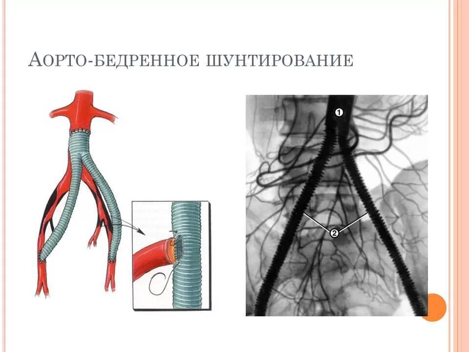 Операция шунтирования нижних конечностей. Аорто бифеморальное шунтирование. Аорта коронарное шунтирование. Синдром Лериша аорто бедренное шунтирование. Бедренно-подколенное шунтирование схема.