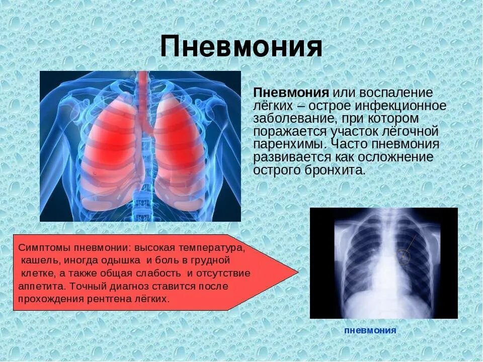 Пневмония нижних отделов легких. Воспаление лёгких и пневмония.