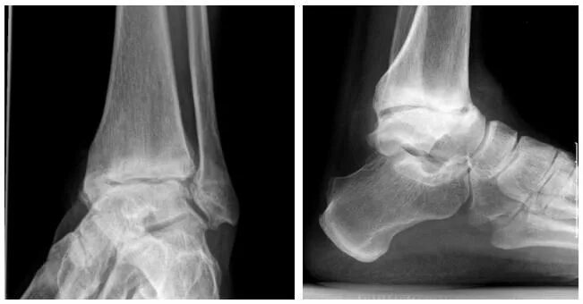 Остеоартроз голеностопного сустава рентген. Подтаранный сустав рентген. Деформирующий остеоартроз стопы рентген. Псориатический артрит голеностопного сустава рентген.