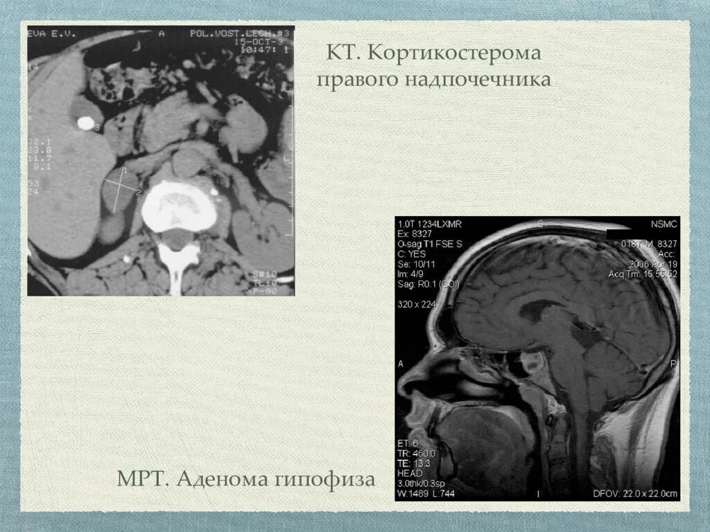 Кортикостерома надпочечника мрт. Аденома гипофиза Иценко Кушинга. Объемное образование гипофиза. Синдромы при аденоме гипофиза.