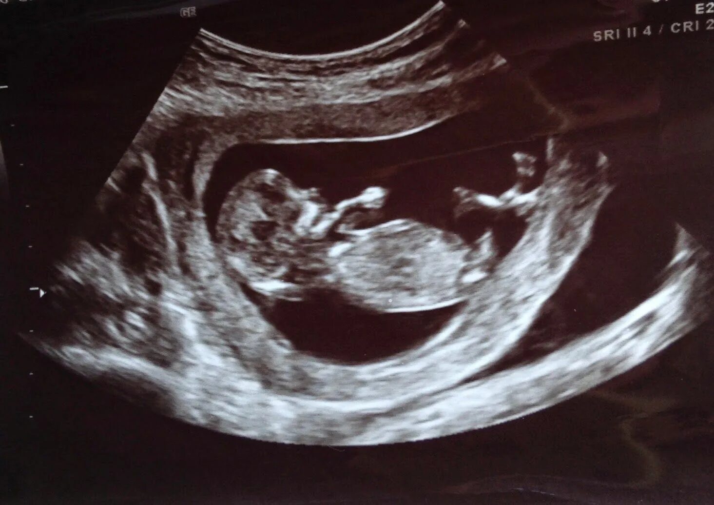 Фото мальчика 12 недель. УЗИ 13 недель беременности мальчик. УЗИ 11-12 недель беременности пол ребенка. УЗИ 12 недель беременности девочка. УЗИ плода 12 недель мальчик.