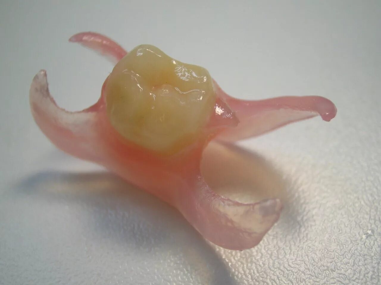 Зубной протез бабочка на зуб один