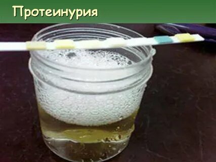 При мочеиспускании моча пенится причина