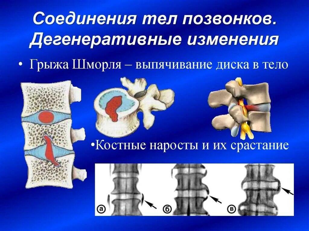 Дегенеративно-дистрофические изменения тела позвонка. Дегенеративно-дистрофические изменения l2 l3. Дегенеративные изменения тел позвонков. Дегенеративно дистрофические изменения дисков.